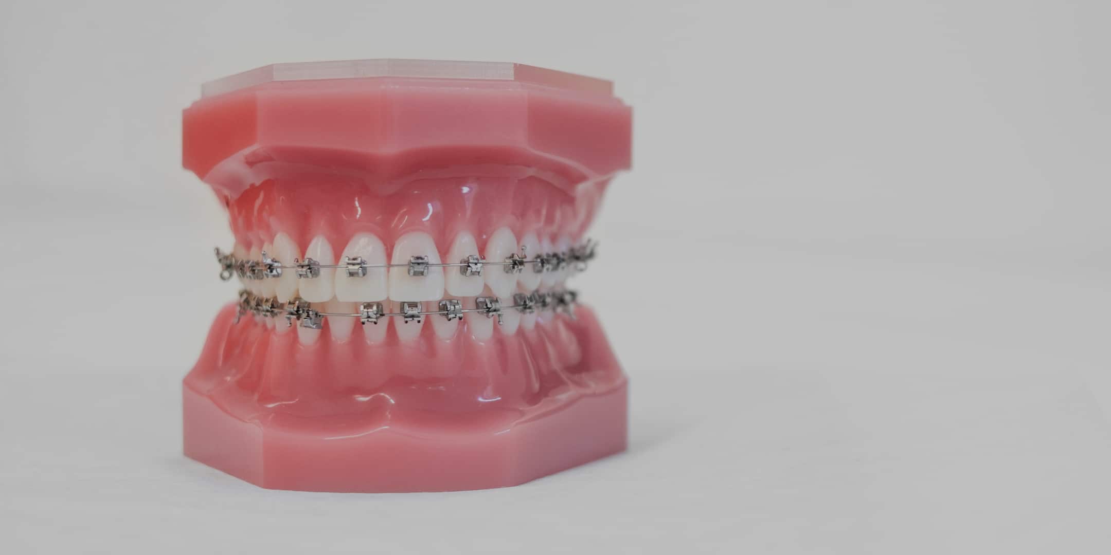 Vanliga frågor om tandställning för barn